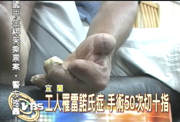 我想幫助罹患「雷諾氏」症的李先生...