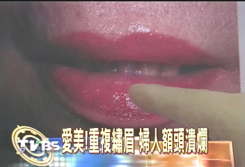 愛美！重複繡眉　婦人額頭潰爛