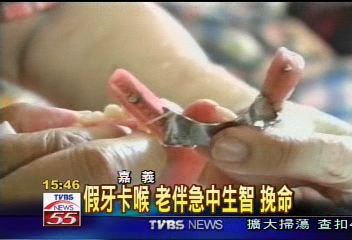 假牙卡喉　老伴急中生智救回一命