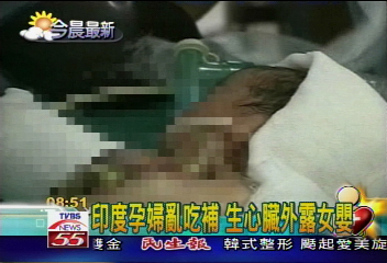 印度孕婦亂吃補 生心臟外露女嬰