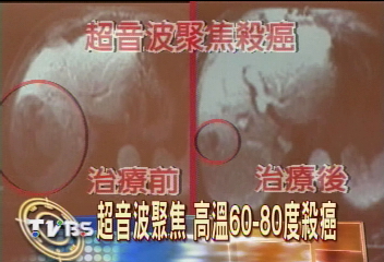 超音波「聚焦」發熱 殺癌免開刀