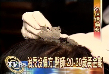 注射維他命　生髮不成反變「疤痕禿」
