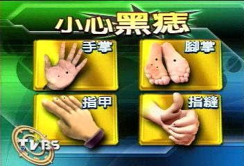 黑痣轉黑色素癌　國人手腳最常見