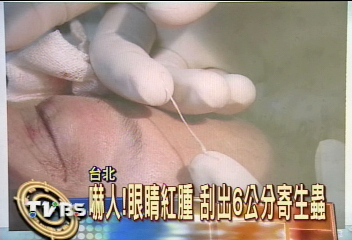 眼睛紅腫 刮出6公分寄生蟲