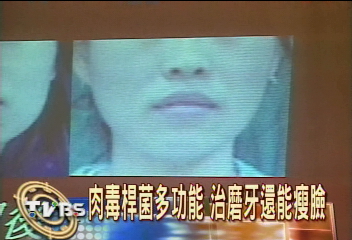 肉毒桿菌新用法　治磨牙也有效