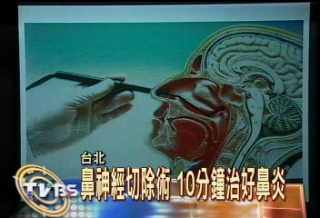 鼻神經切除術 10分鐘治好鼻炎