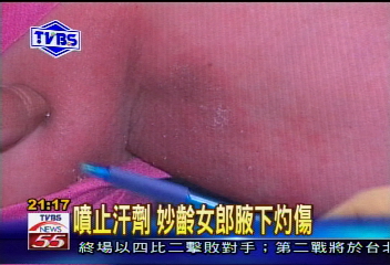 噴止汗劑 妙齡女郎腋下灼傷