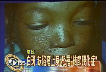 白斑 缺陷瘤上身 恐罹「結節硬化症」