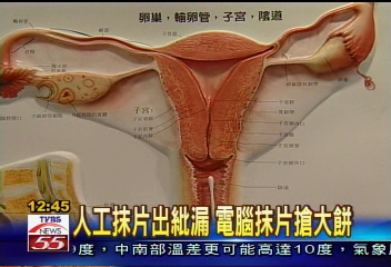 子宮頸「電腦」抹片 準確度95%