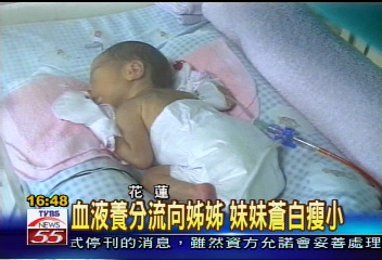 雙胞胎分大小號　罕見輸血症候群