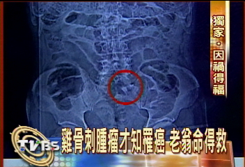 〈獨家〉雞骨刺腫瘤才知罹癌 老翁命得救