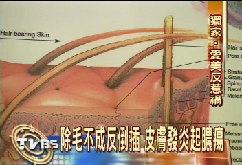 除毛海綿害人　大學妹發炎毀美腿