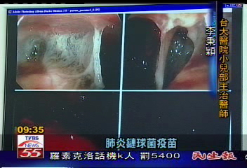 小感冒染上肺炎　幼兒致命風險高