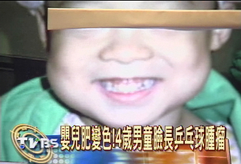 嬰兒肥變色! 4歲男童臉長乒乓球腫瘤
