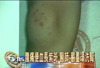 6歲女童腿長紫斑 誤診險成腎衰竭