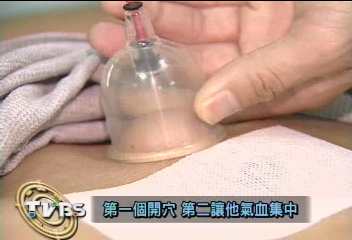 冬令進補用「貼」的　三九貼治氣喘