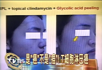 是「癌」不是「痘」! T細胞淋巴癌