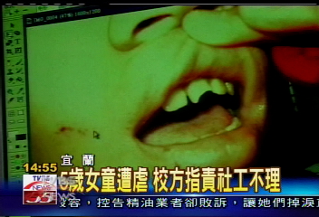虐童？小五童臉被刀刮　牙齦瘀青
