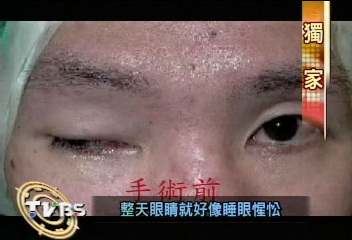 〈獨家〉彈珠汽水爆炸傷眼皮 「矽膠棒」可醫