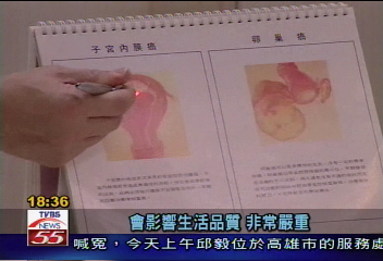天然雌激素食品　易致子宮內膜癌