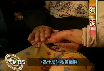 〈獨家〉9歲女童吃火鍋 全身1/4燒傷