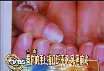 恐怖！婦人手指紅斑不退　竟罹乳癌