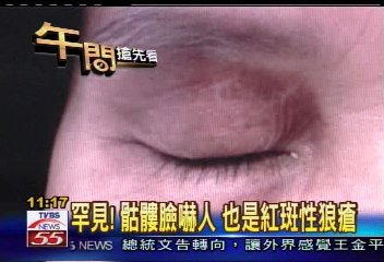 〈獨家〉熟女「熊貓眼」 紅斑性狼瘡作祟
