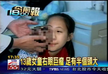 13歲女童右眼巨瘤 足有半個頭大