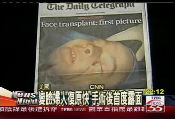 變臉婦人復原快　手術後首度露面