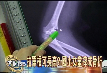 拉單槓可長高?國小女童摔成骨折