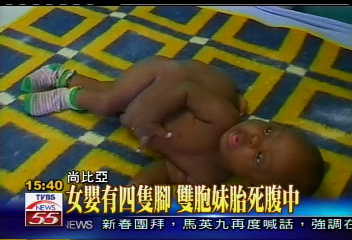 女嬰有四隻腳　雙胞妹胎死腹中