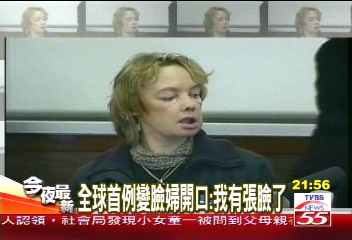 全球首例變臉婦開口:我有張臉了