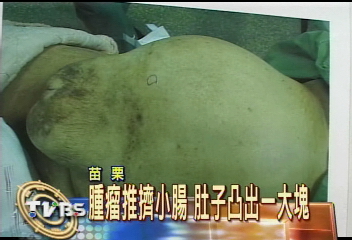 婦1年胖20KG　「平滑肌肉癌」作祟