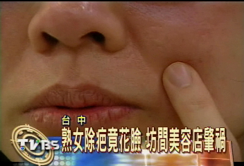 熟女除疤竟花臉 坊間美容店肇禍