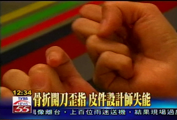 骨折開刀歪指 皮件設計師失能