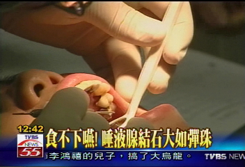 食不下嚥！　唾液腺結石大如彈珠