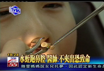 鼻子超癢噴血　原來是水蛭作怪！