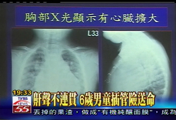 鼾聲不連貫　6歲男童插管險送命