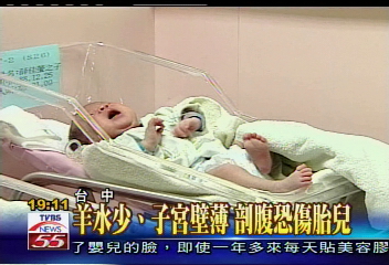 〈獨家〉羊水少、子宮壁薄 剖腹恐傷胎兒