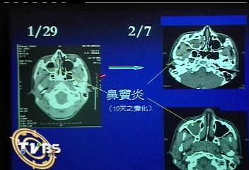 鼻竇炎穿腦 男孩額頭長膿包