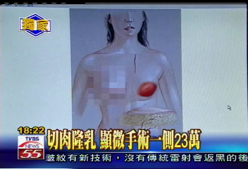 〈獨家〉切肉隆乳 顯微手術一側23萬
