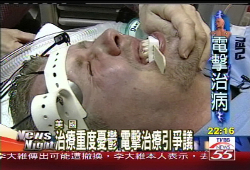 治療重度憂鬱 電擊治療引爭議