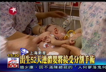 出生52天　連體嬰將接受分割手術
