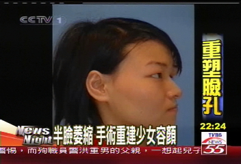 半臉萎縮　手術重建少女容顏
