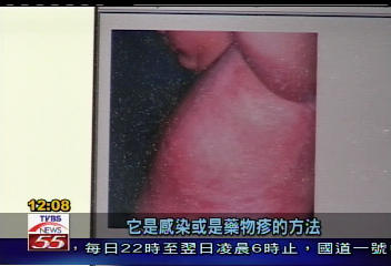 吃感冒藥　男子生殖器竟過敏潰爛！