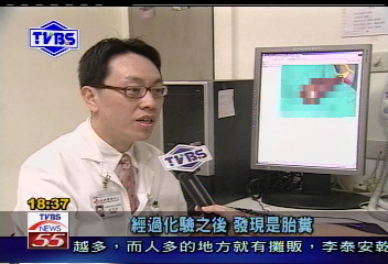 〈獨家〉台灣首例!「胎糞」變結石 睪丸壞死
