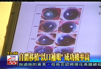 口腔細胞可重建眼角膜　視障福音