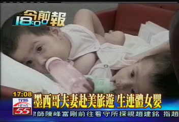 墨西哥夫妻赴美旅遊 生連體女嬰