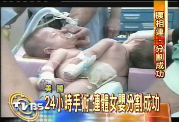 24小時手術 連體女嬰分割成功