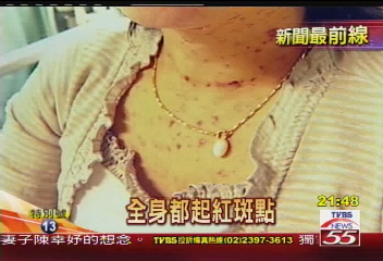 〈獨家〉吃降尿酸藥 婦人全身紅疹過敏